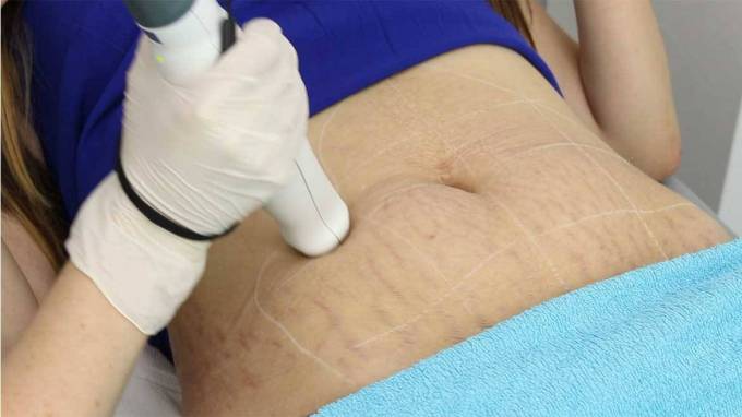 How Does Laser Technology Improve Stretch Marks Removal?