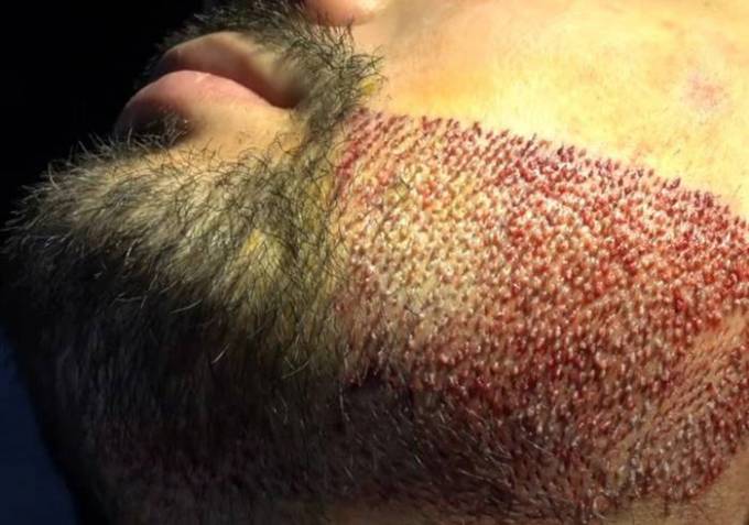 What Are the Limitations of a Beard Hair Transplant?
