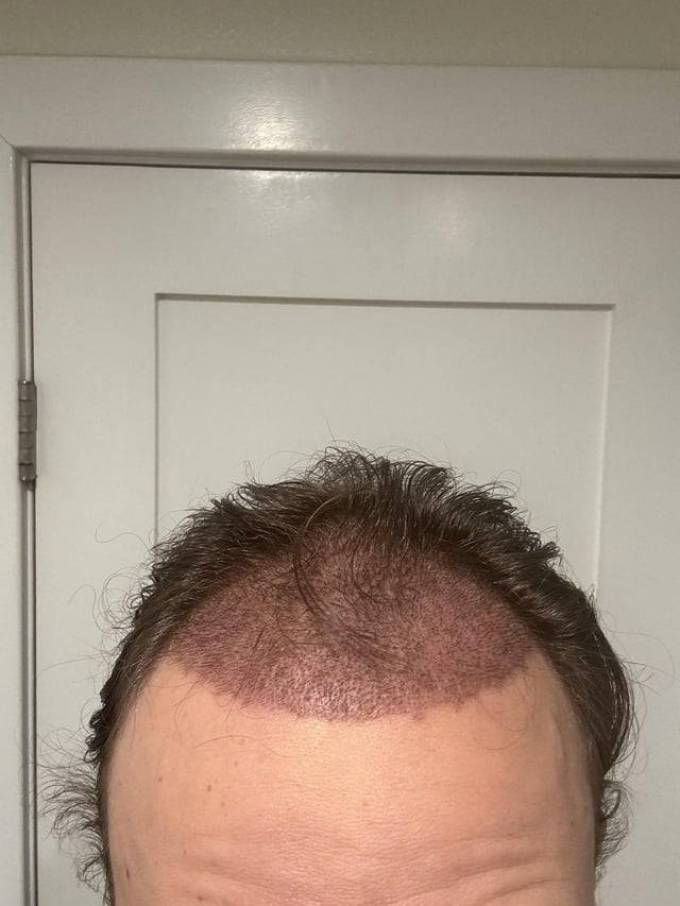 What Determines Crown Hair Transplant Quality?
