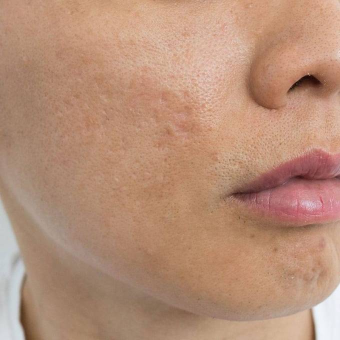 How Does Age Impact Acne Scar Treatment Effectiveness?