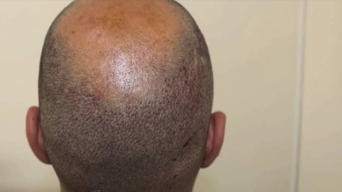 Is FUT Hair Transplant Suitable for All Hair Types?