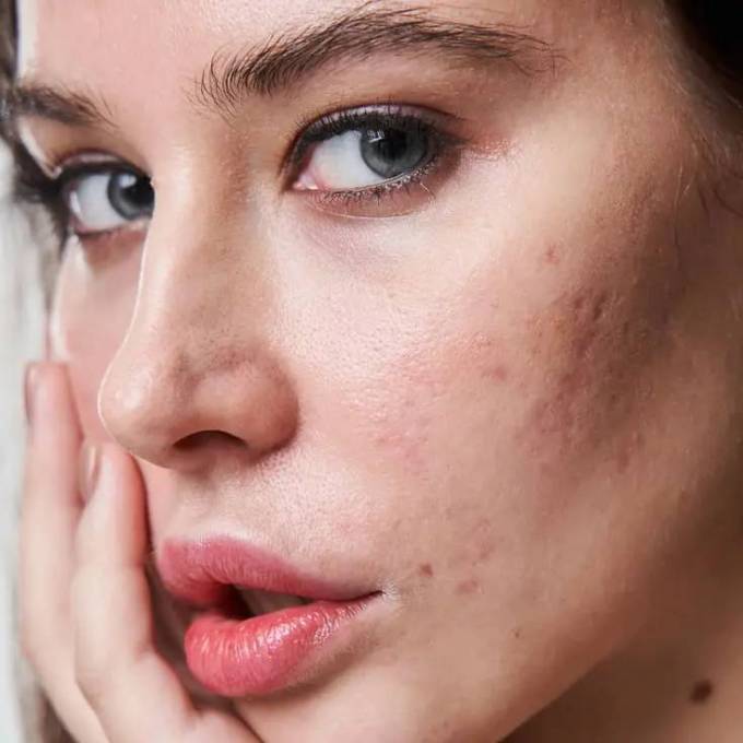 Does Acne Scar Treatment Work on Deep Scars?