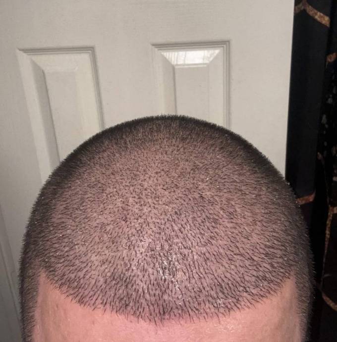 How Does Robotic Hair Transplant Improve Hair Density?