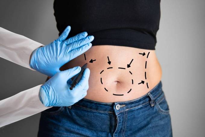 What Factors Affect a Tummy Tuck Cost?