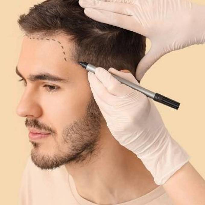 What Are the Stages of Hair Transplant Recovery?