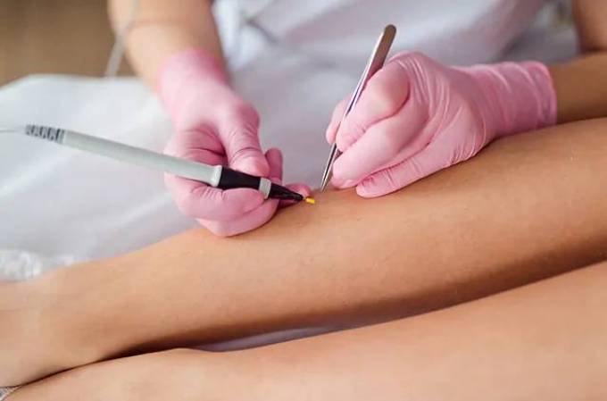 Does Electrolysis Hair Removal Target The Hair Follicle?