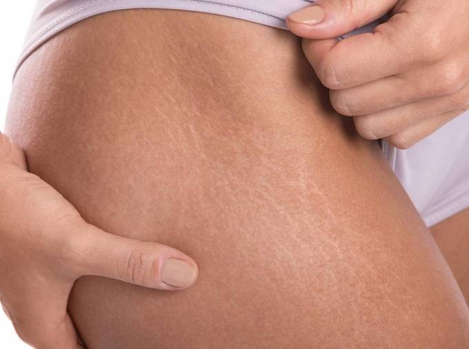 How Professionals Perform Laser Stretch Marks Removal?