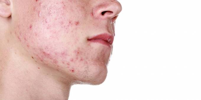How Do Professionals Assess Acne Scar Treatment Needs?
