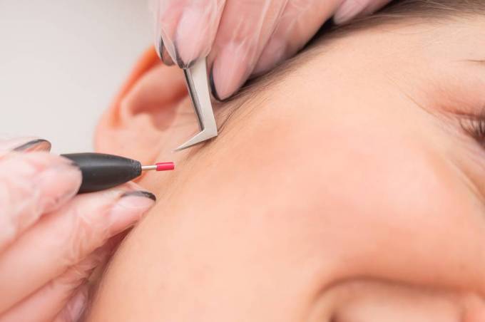 How Does Electrolysis Hair Removal Achieve Permanence?