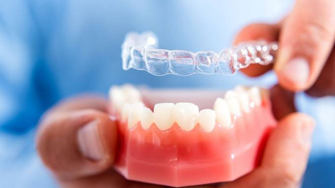 What Should The Best Aligners Provide?