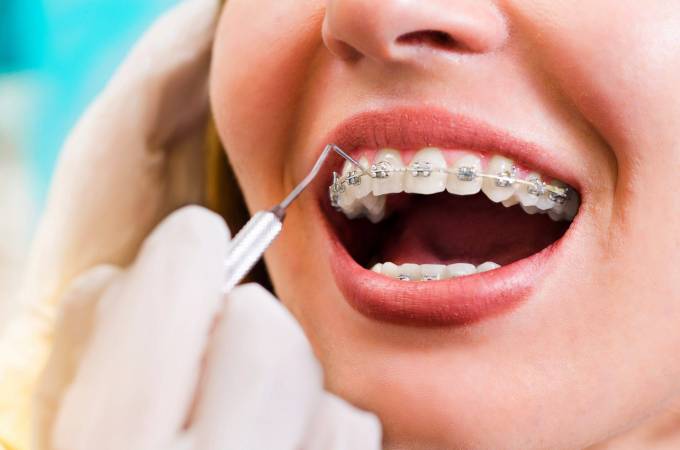 How Do Braces Move Teeth Safely?