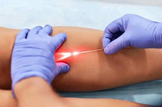 What Is The Role Of Imaging In Varicose Veins Treatment?