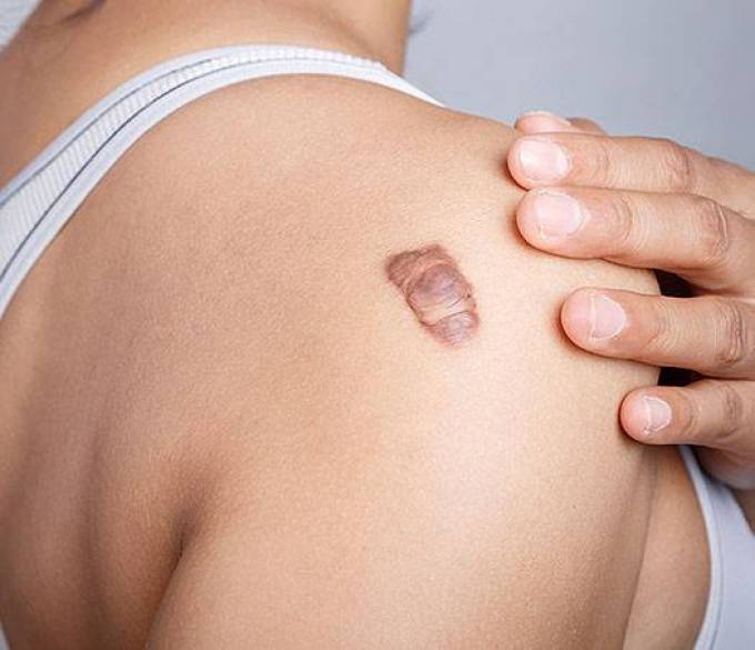 How Is Pressure Therapy Applied For Keloid Treatment?