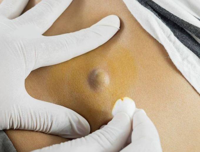 Is Incision and Drainage of Abscesses Always a Necessary Treatment?