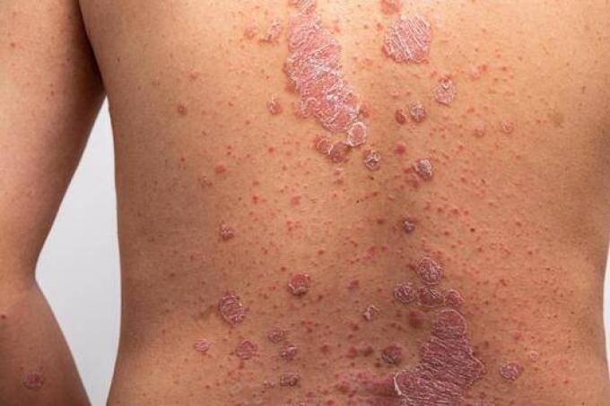 What Does Holistic Management In Skin Diseases Treatment Mean?