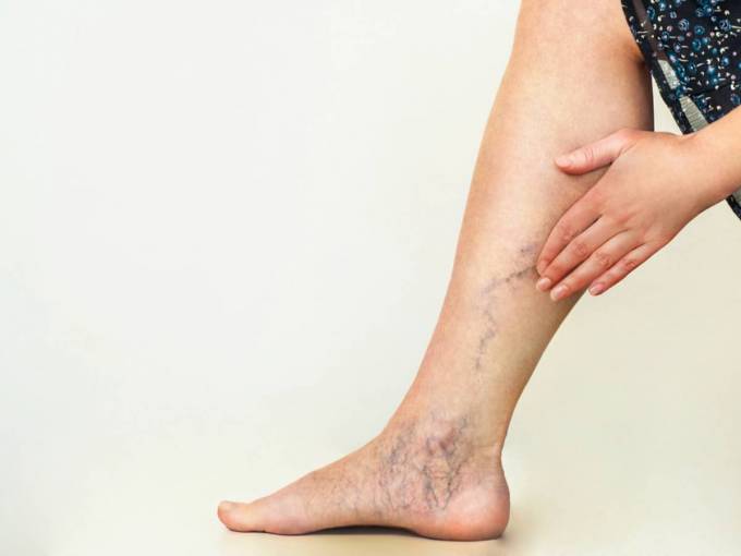 How Is A Treatment Plan For Varicose Veins Developed?