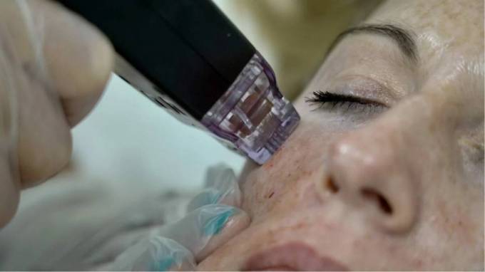 How Morpheus8 Combines Thermal and Mechanical Effects