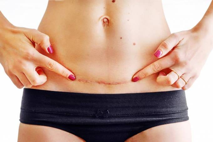 What should patients understand about mini abdominoplasty?