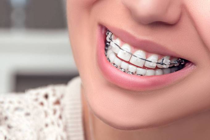 How Do Ceramic Braces Fit the Dental Arch?
