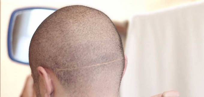 How is FUT used for hair loss?