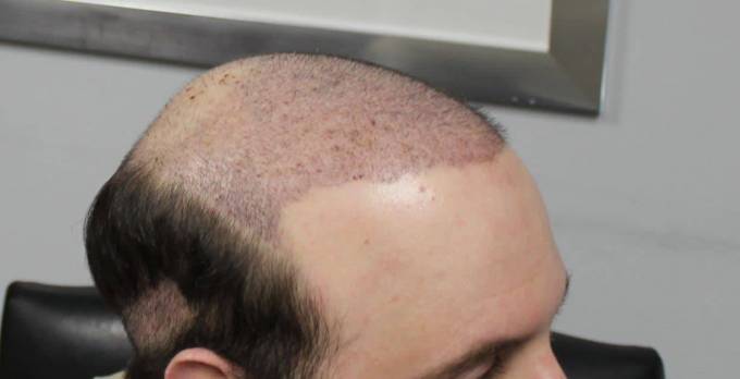 What Qualifications Should a Hair Transplant Clinic Have?