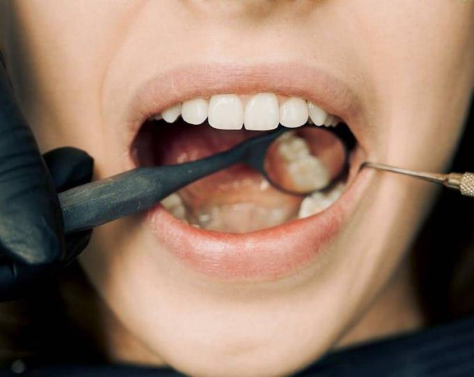 What happens during dental calculus removal treatment?