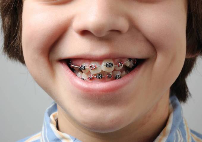 How Do Permanent Retainers Affect Long-Term Teeth Straightening and Alignment?