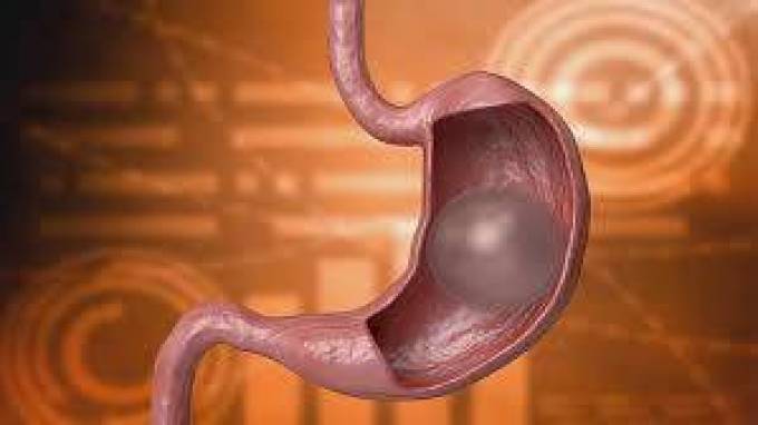 Is Gastric Balloon Placement a Temporary Medical Intervention?