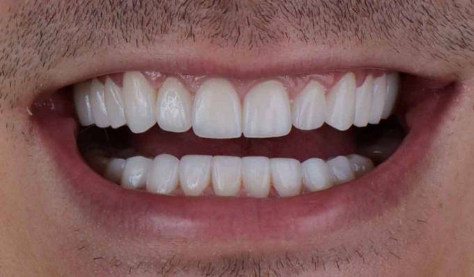 What are Hollywood Smile design options?