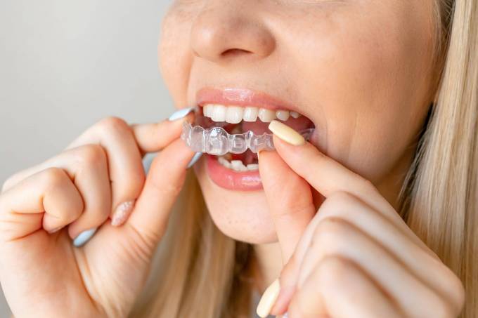 What Does Invisible Lingual Braces Treatment Involve?