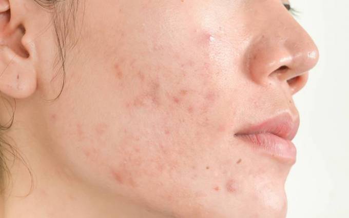 How Inflammation Relates to Acne Scar Treatments?