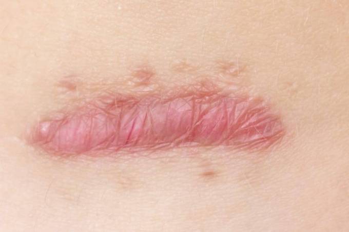 What Scar Removal Options Are Evidence-Based?