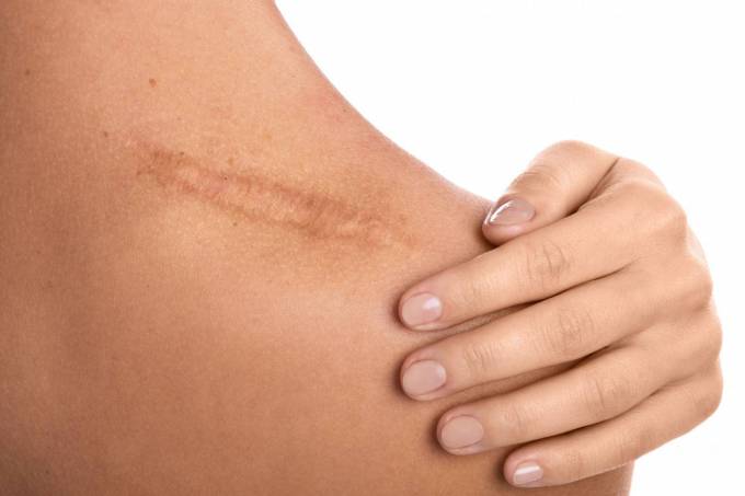 What Does Surgical Scar Revision Entail for Mature Scars?