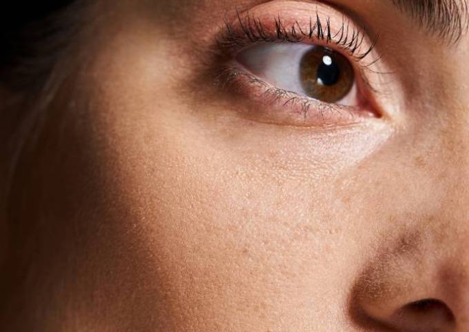 Is Eye Bag Removal Based on Skin or Muscle Changes?