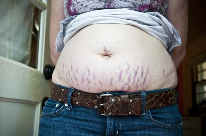 What Stretch Marks Removal Means Clinically?