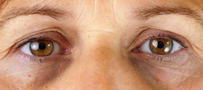 How Dark Circles Treatment Affects Skin Layers?