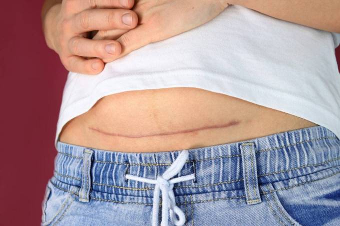 Is Scar Removal Considered Reconstructive Care?