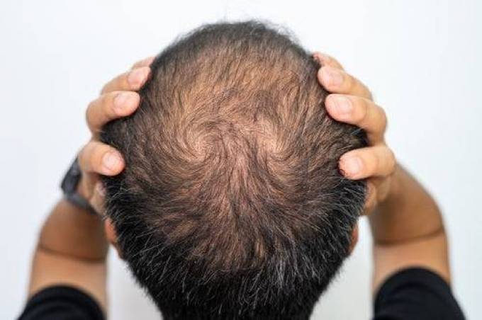 What Crown Hair Transplant Requires Before Surgery?