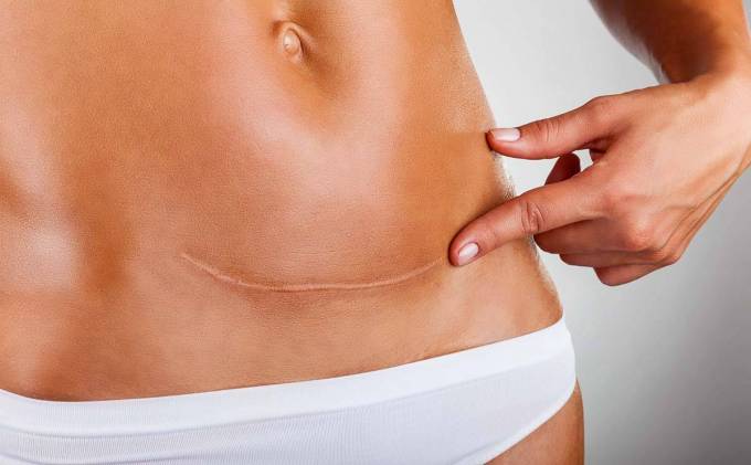 What Does Surgical Scar Revision Entail for Mature Scars?