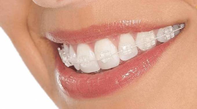 Does the Design of Invisible Lingual Braces Affect Bite Function?