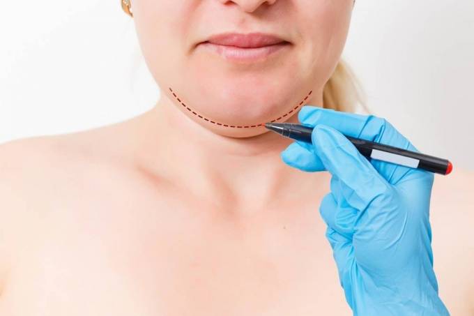 What Does Double Chin Liposuction Target Anatomically?