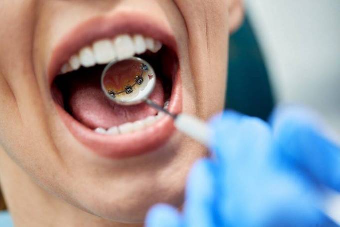 Does Invisible Lingual Braces Move?