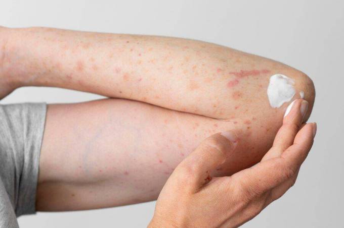 Who Qualifies for Skin Diseases Treatment?