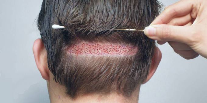 What is the tissue preservation method in FUT Hair Transplant?