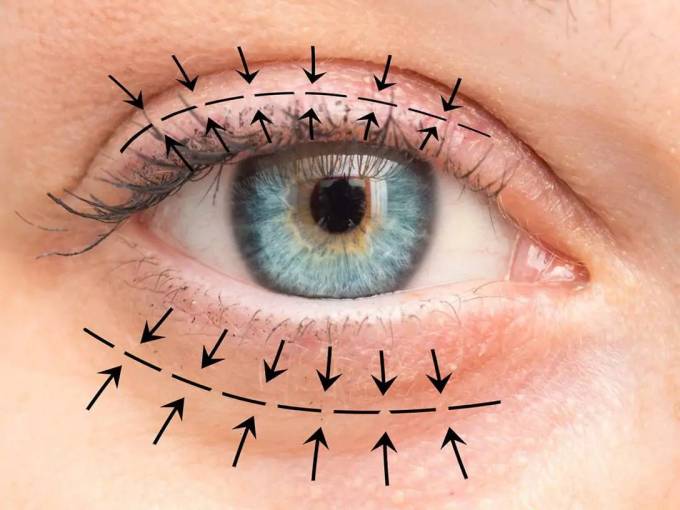 How Does Blepharoplasty Work?