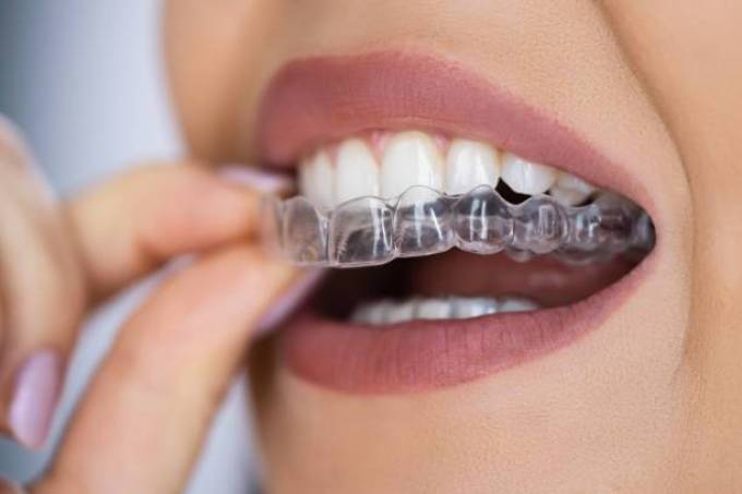 How Do Mouth Guards Prevent Injury?