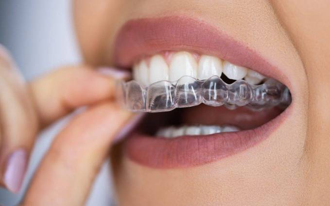 Why Choose Aligners for Teeth Straightening?