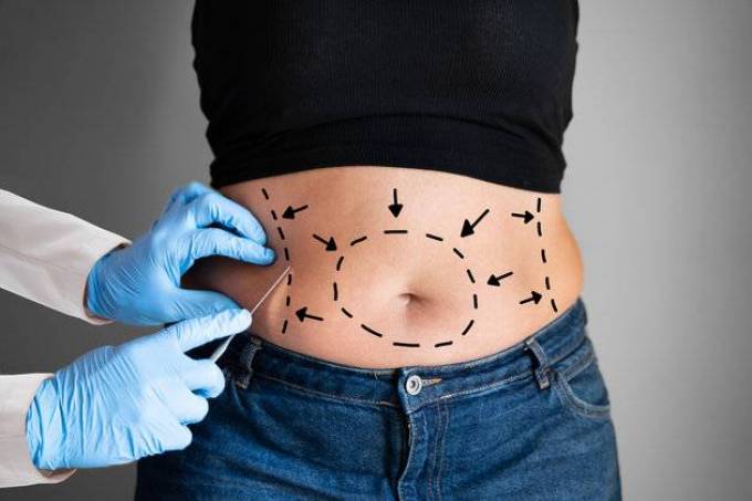 How does Liposuction treatment remove fat?