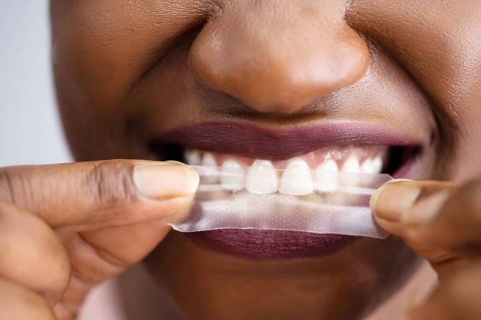 Teeth Whitening Strips Who Should Avoid Them?