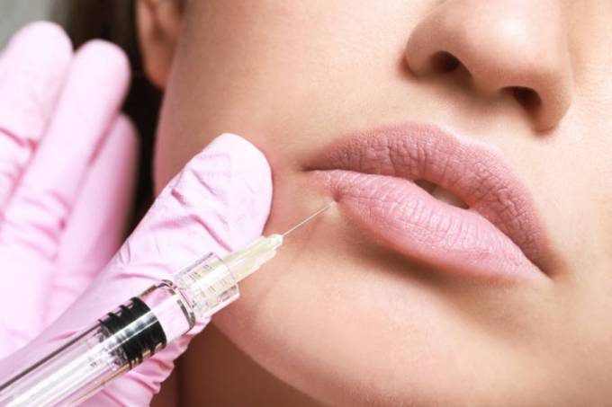 How Are Volbella Fillers for Lips Administered?